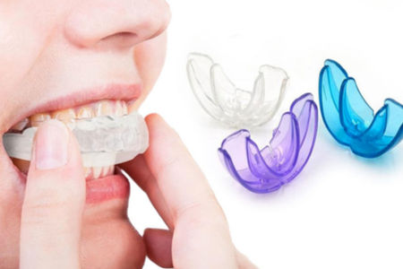 Une gouttière d’alignement dentaire en silicone - correcteur de contention orthodontique