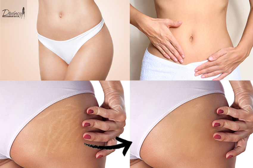 Soin Dermabooster anti-vergeture (75min)