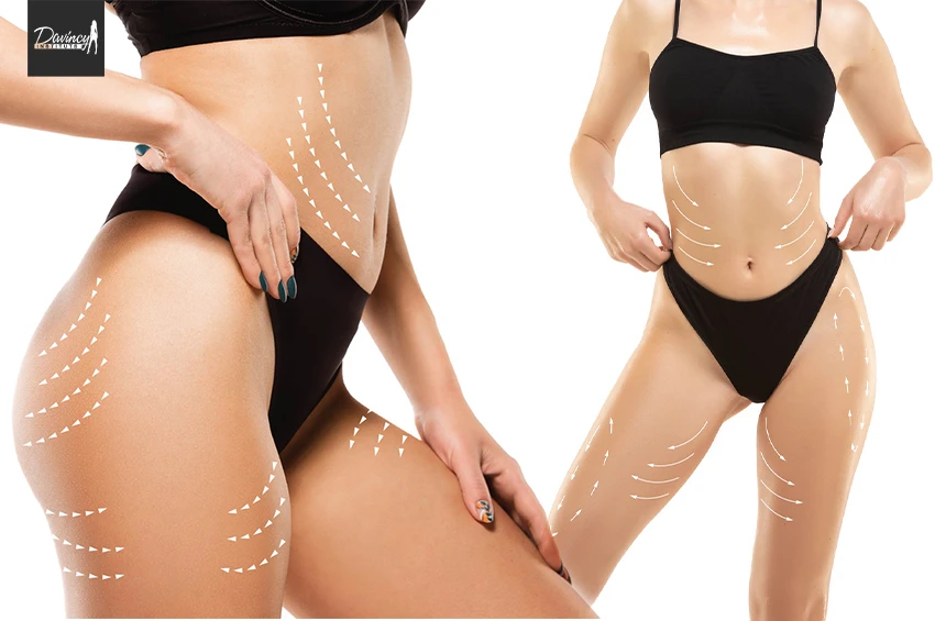 LPG Dernière génération avec l'infinity (80 min)