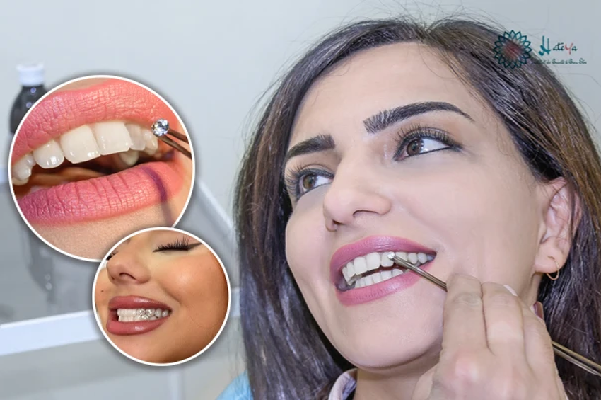 Pose strass dentaire (Cristal Swarovski)