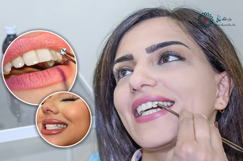 Pose strass dentaire (Cristal Swarovski)