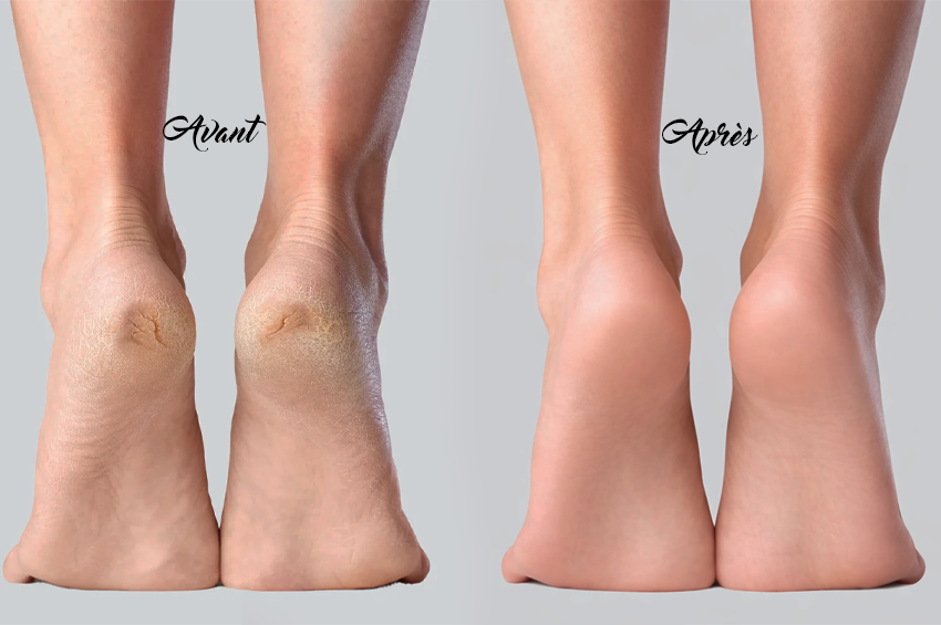 Soin anti-callosités des pieds