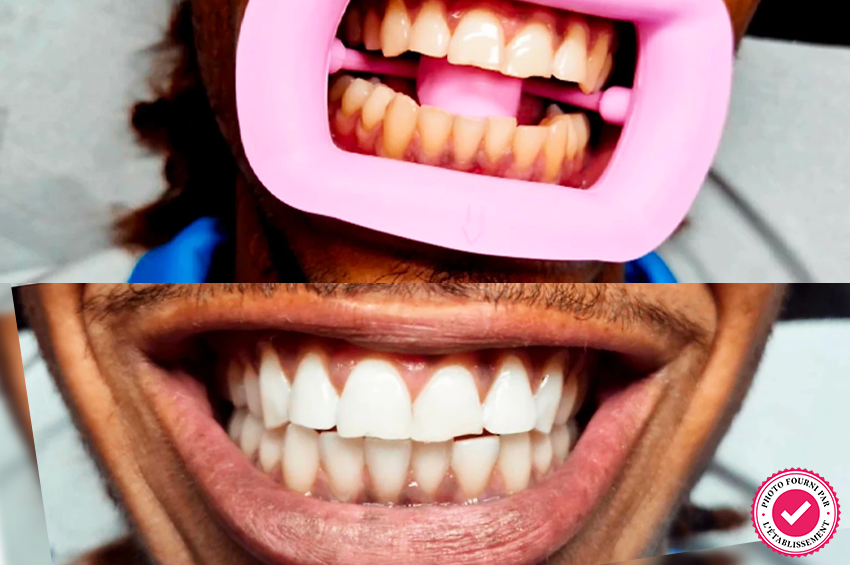 Blanchiment dentaire complet (1h)