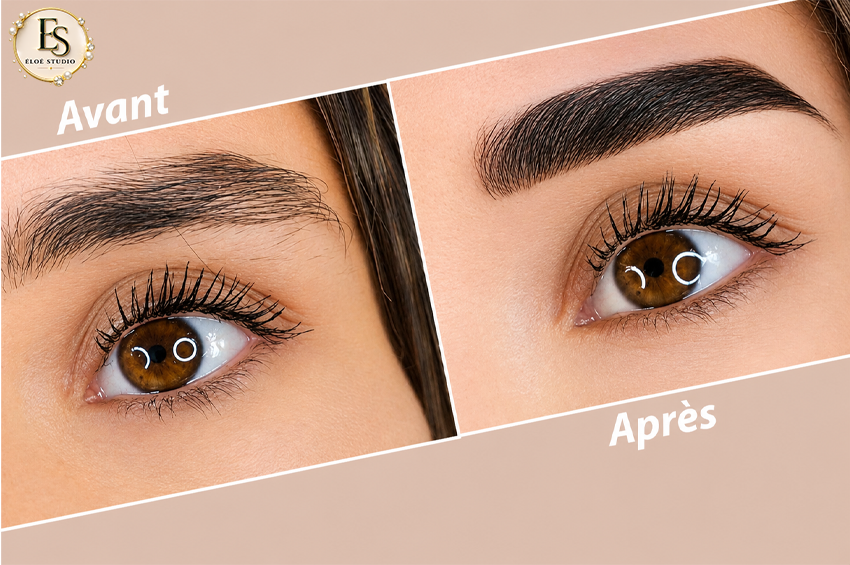 Restructuration des sourcils : BrowLift