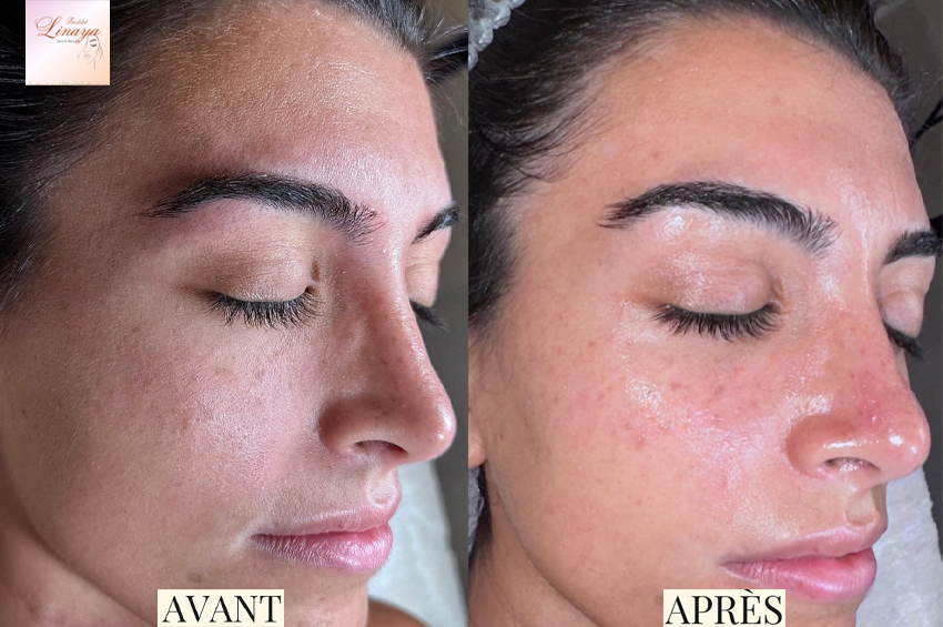 Soin hydraskin coréen (1h)